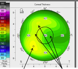 Corneal Edema