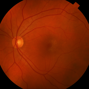Introduction to Dry AMD and Geographic (Macular) Atrophy