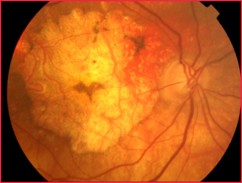 Imagerie et diagnostic différentiel de l’atrophie géographique