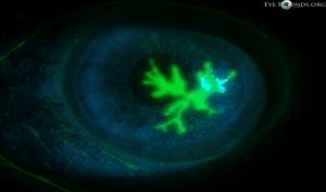 Neurotrophic Cornea
